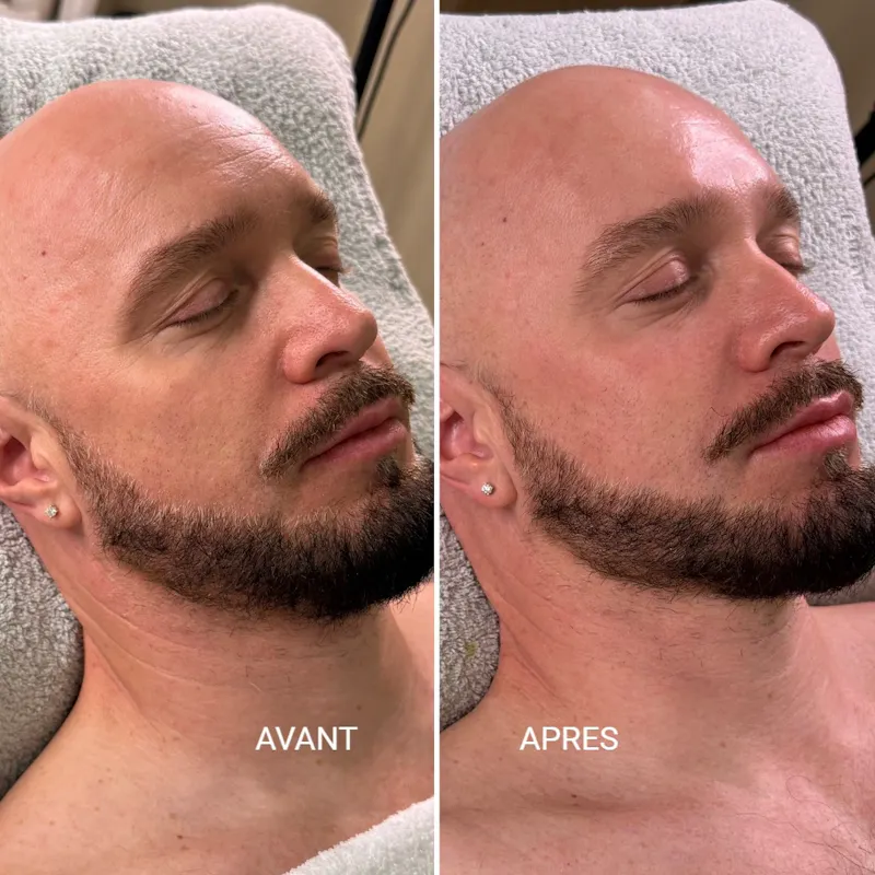 PEELING BioRePeel