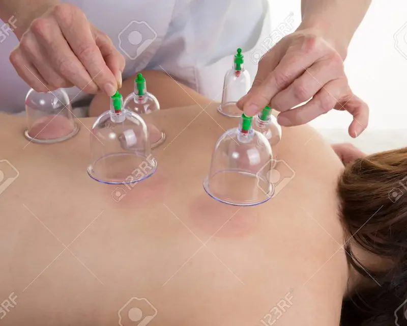 Les ventouses en Médecine Chinoise