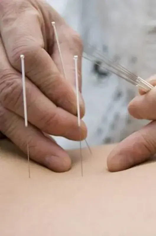 Photo de Acupuncture Traditionnelle
